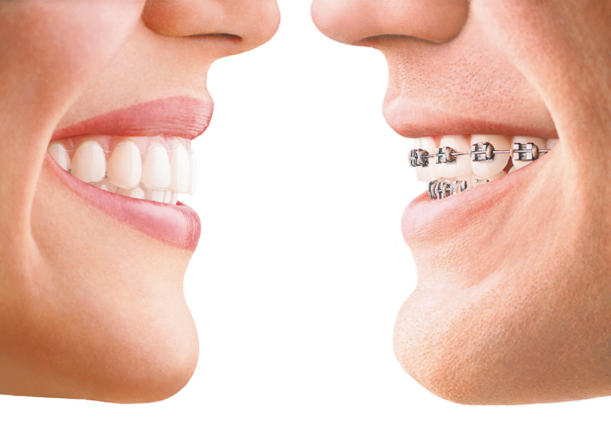 Invisalign in Bangalore | Invisible braces | Little pearls dental | Orthodontists