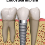 Endosteal implants