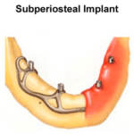 Subperiosteal Implants