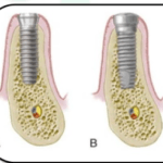 Two stage implants