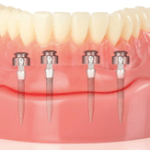 Mini dental implants