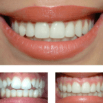 Cosmetic dentist, Teeth whitening & bleching dental veneers, teeth bonding