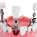 Dr Pavan - Prosthodontist in Bangalore | Partial dentures & complete denture expert.