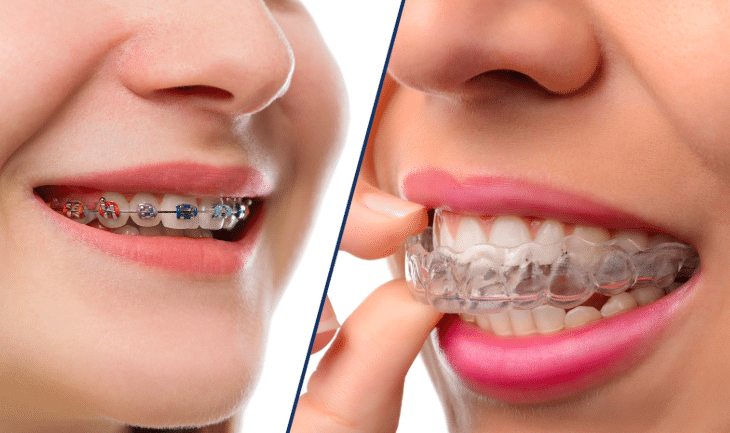 How does invisalign work? Invisalign is the clear alternatve to braces.