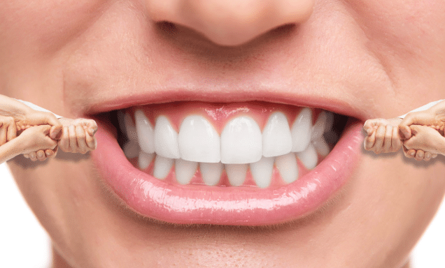 How does invisalign work? Invisalign is the clear alternatve to braces.