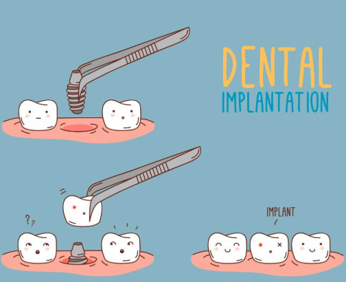 Dental implant procedure | the truth about dental implants