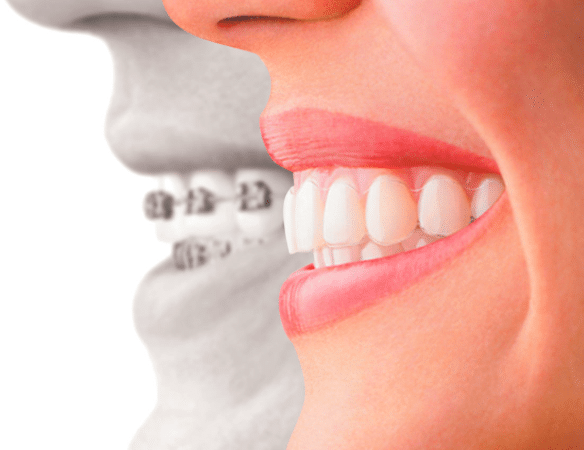 Little Pearls Orthodontics - Experienced Orthodontists for Braces & Clear aligners.