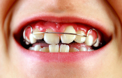 Orthodontist inBangalore - Advanced orthodontics clinic for braces and Invisalign.