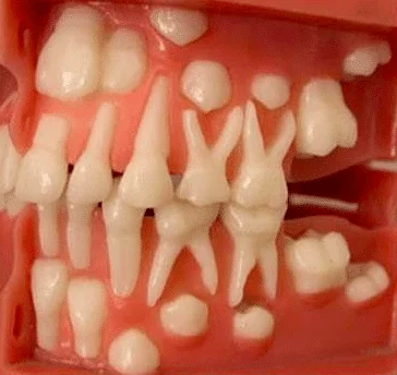 How many milk teeth does a child have? - Pediatric dentists at Little pearls dentistry.