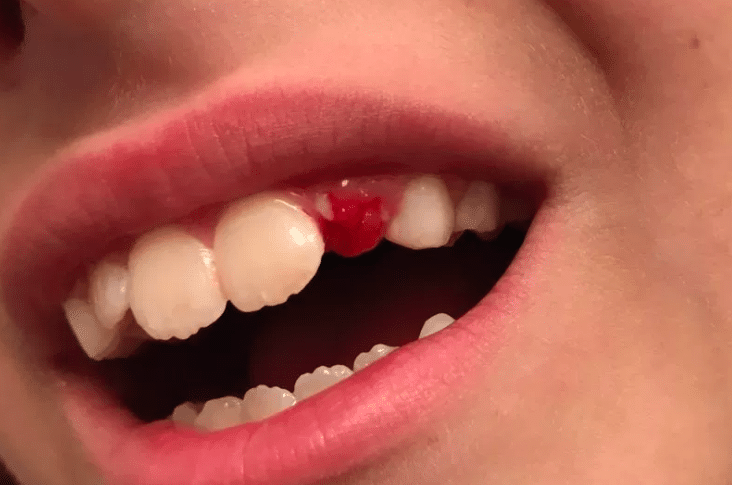 How many milk teeth does a child have? - Pediatric dentists at Little pearls dentistry.