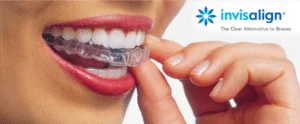 Invisalign aligners Bangalore