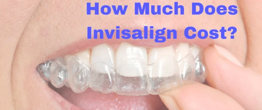Invisalign cost in bangalore