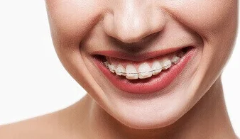 Can adults wear braces
