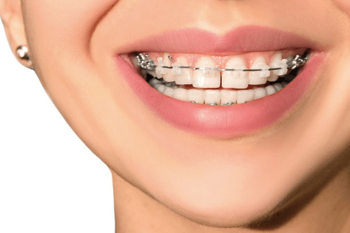 What You Need to Know About Braces and Orthodontics