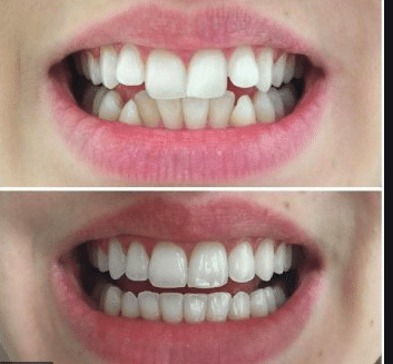 Best Invisalign Treatment in South Bangalore