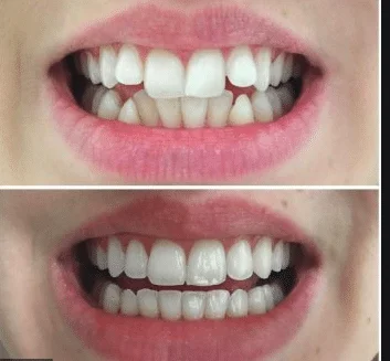 Best Invisalign Treatment in South Bangalore