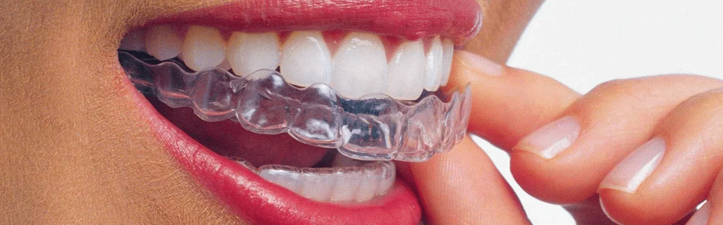 Invisalign cost in Bangalore India