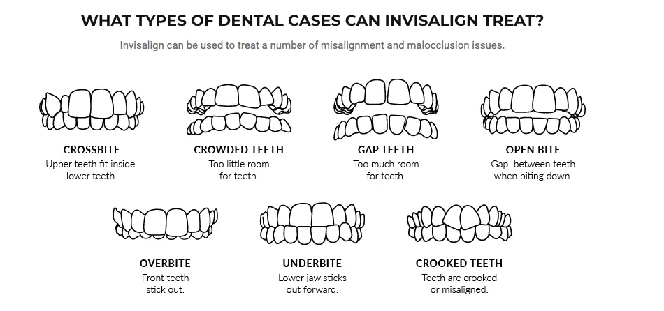 What are the types of Invisalign and how much does it cost? Clear Aligner variants and their average price in Bangalore