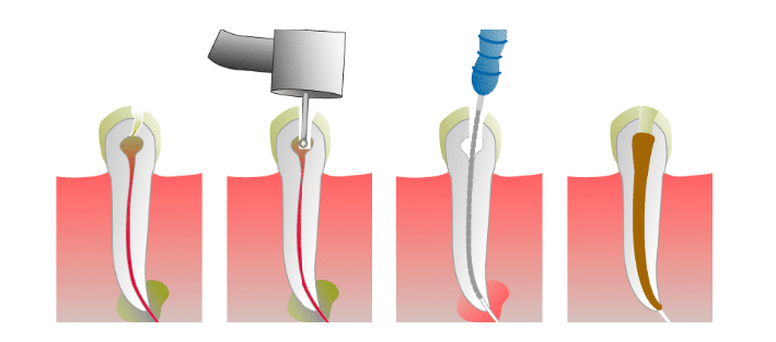 What is Root canal treatment - By Little Pearls dental clinic Bangalore