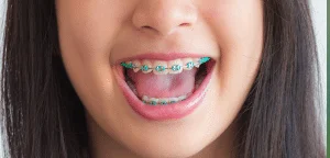 Early childhood braces for kids