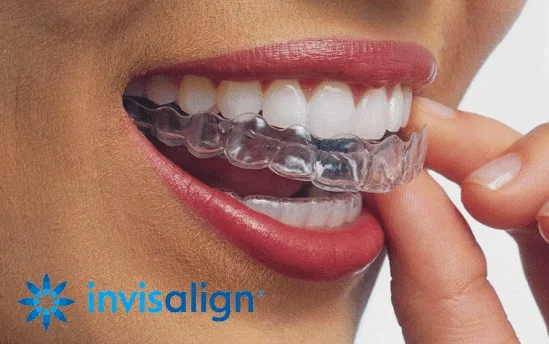 Invisalign Invisible Braces in Bangalore