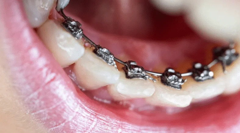 Lingual Braces in Bangalore