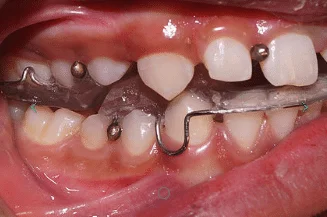 Myofunctional Orthodontic Appliances