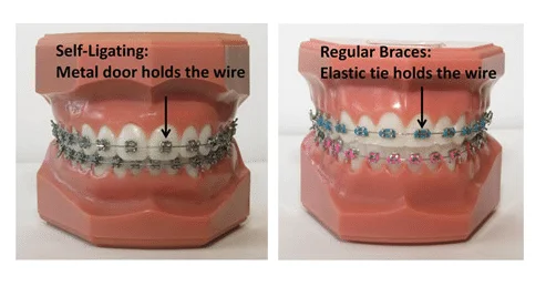 Self Ligating Braces at Little Pearls Orthodontics