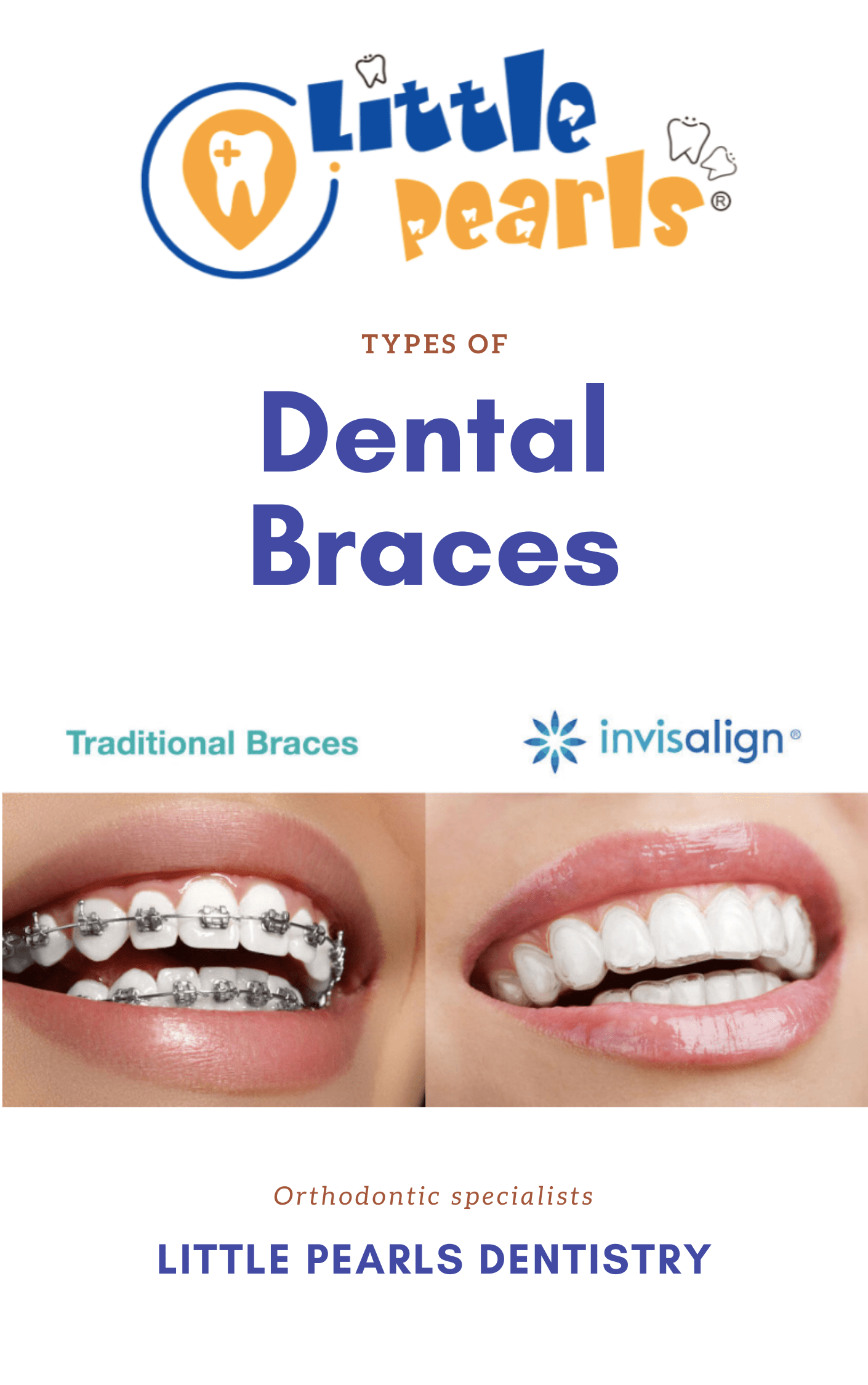 Types of dental braces