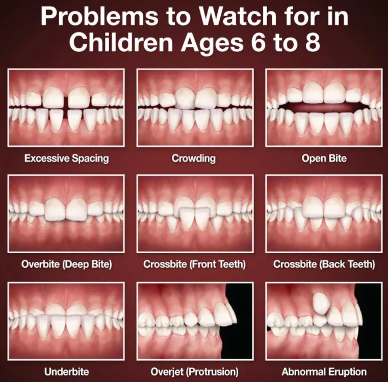 Braces treat malocclusions in kids
