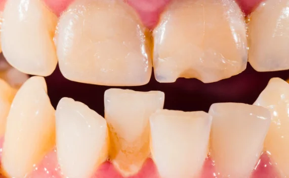 Crooked Teeth correction in Bangalore using early childhood braces braces