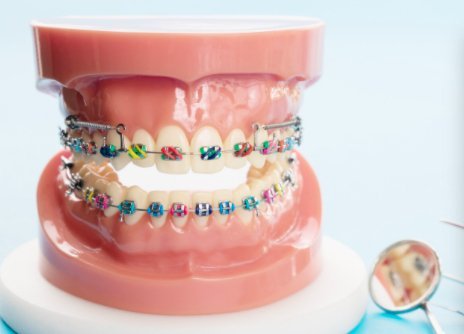 Early Childhood Braces for Kids in Bangalore at Little Pearls Orthodontics.