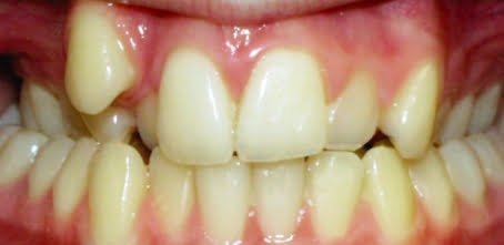 Overcrowded Teeth teeth correction using braces