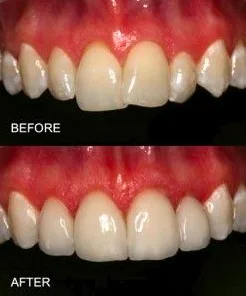 Overlapping Teeth correction using braces