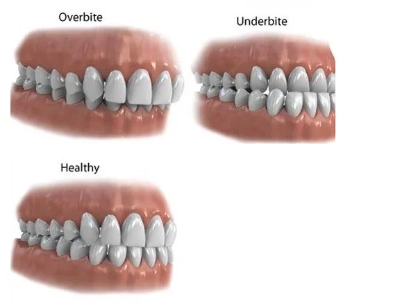 Underbites and Overbites correction using braces