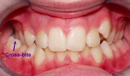 Braces correct cross bites in kids