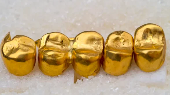 Advantages of Gold Dental Crowns