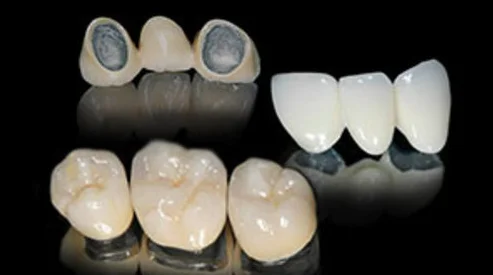 Advantages of PFM Dental Crowns