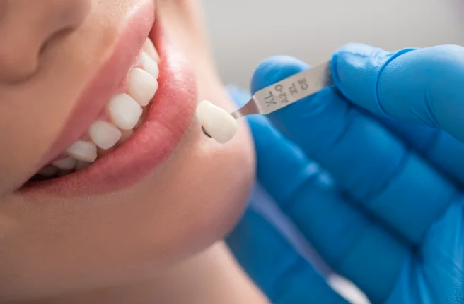 Advantages of Porcelain Dental Crowns