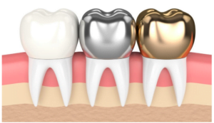 Different Types of Dental Crowns