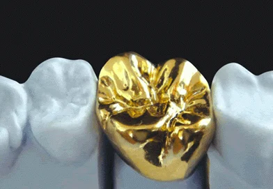 Disadvantages of Gold Dental Crowns