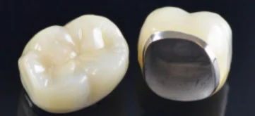 Porcelain Fused-to-Metal Crowns (PFM)