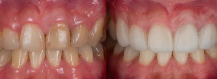 Treatment with dental crowns before and after