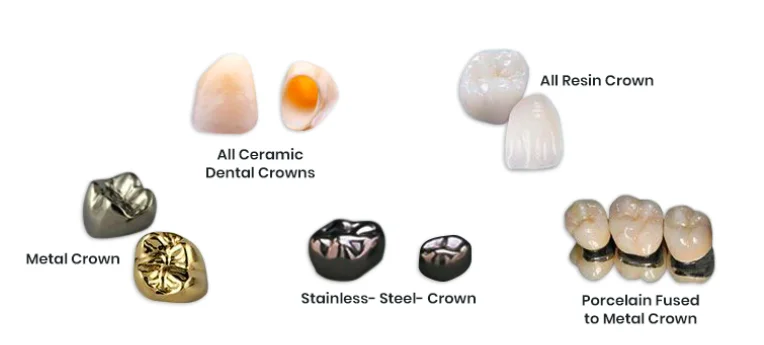 Types of Dental Crowns in Bangalore