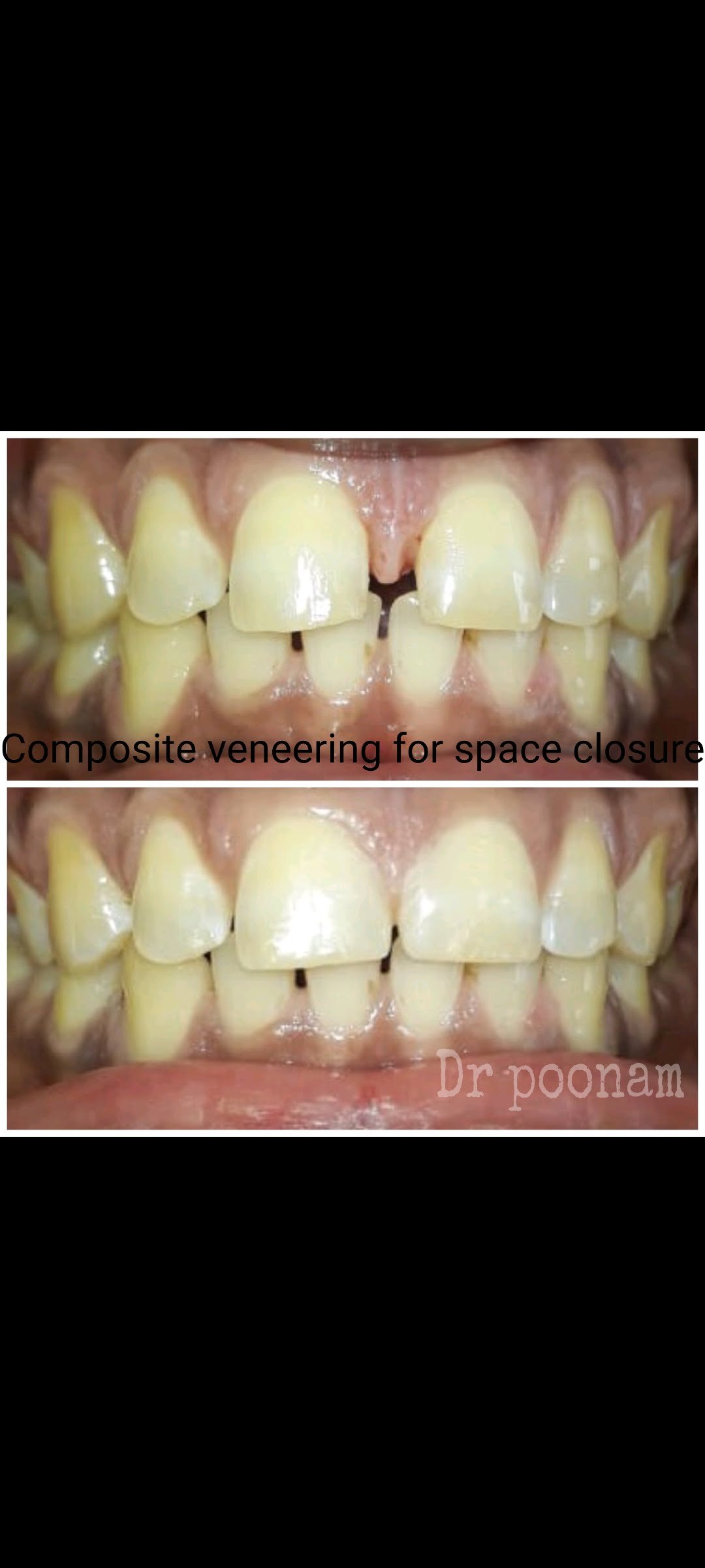 Composite dental veneers by Dr Poonam