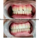 Composite direct veneers by Dr Poonam at Little Pearls Dental