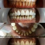 Dental bridge by Dr Poonam at Little Pearls