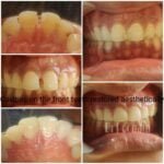 Dental cavities restoration by Dr Poonam at Little Pearls