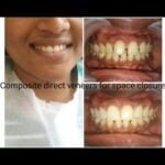 Dental laminates for space closure by Dr Poonam at Little Pearls