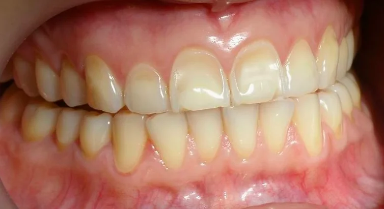 Tooth Mousse Prevents Enamel Erosion